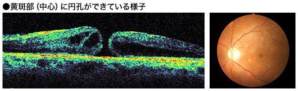 黄斑円孔の症例写真