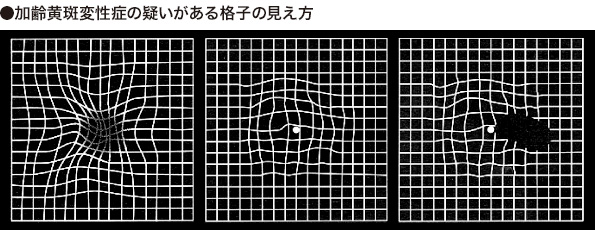 加齢黄斑変性の場合に見える格子の歪み方の図